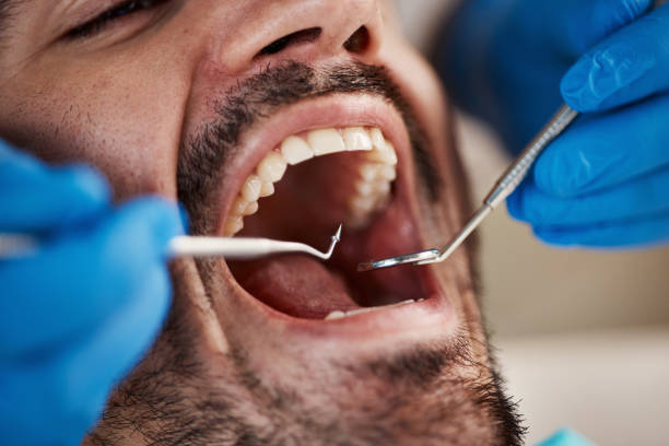 Best Emergency Tooth Extraction in Canton, OH